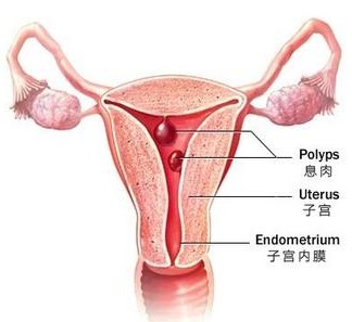 发生子宫肌瘤的因素是什么?