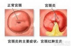 宫颈息肉会不会影响孕育呢?